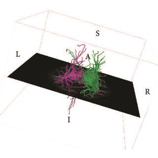 DTI fiber tracking imaging showing fiber tracts indicating stronger... | Download Scientific Diagram