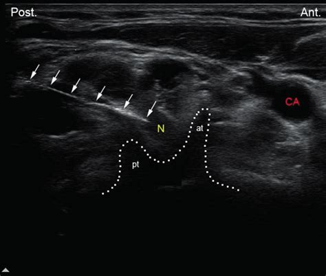 A C6 Level Short Axis Transverse Ultrasound Image Showing The Sharp Download Scientific