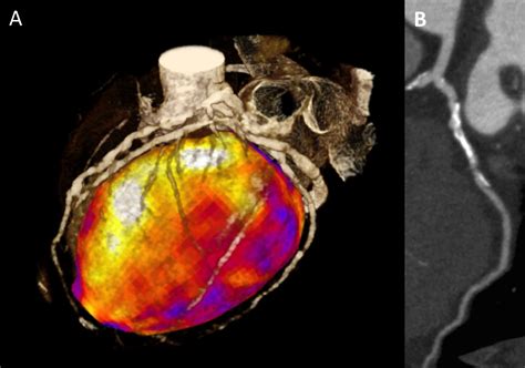 Image Of The Month November Ct Myocardial Perfusion Imaging To