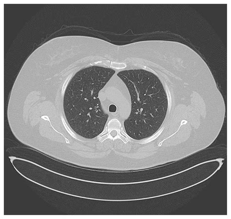 Pneumopathie Dhypersensibilité Après Une Exposition Professionnelle à