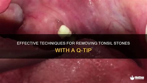 Effective Techniques For Removing Tonsil Stones With A Q Tip Medshun