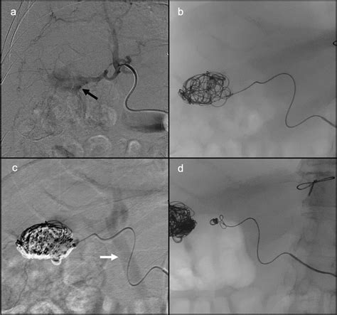 Super Selective Arteriography By Microcatheter Of A Branch Of The Rha