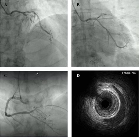 Frontiers Case Report Implantable Cardioverter Defibrillator