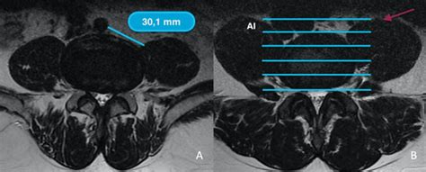 A 47 Year Old Woman T2 Mri At L4l5 Disc Level With Grade 3 Oblique Download Scientific