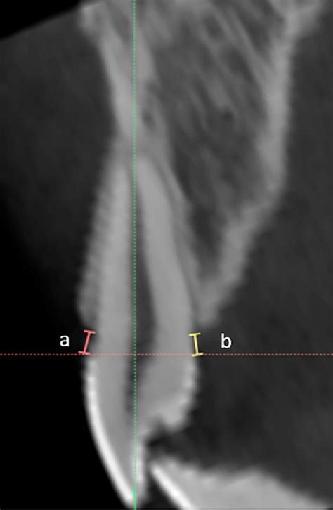 Buccal Alveolar Crest Height A Distance Between The Cemento Enamel