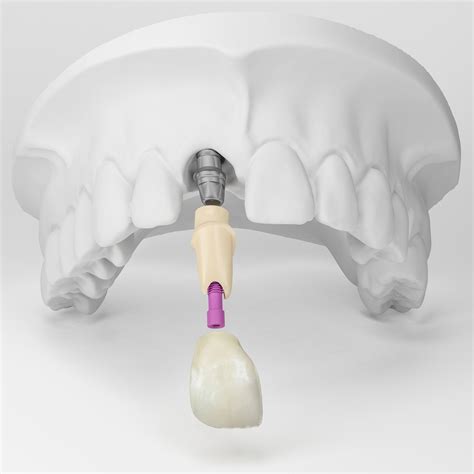 Protesis Sobre Implantes Tipos Y Ventajas Tacna Images