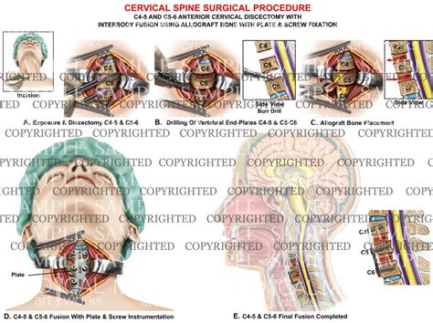 2 Level C4 5 And C5 6 Cervical Discectomy And Fusion Medical Art Works