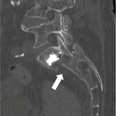 A Anteroposterior Pelvic Radiograph Showing Bilateral Sacroplasty B