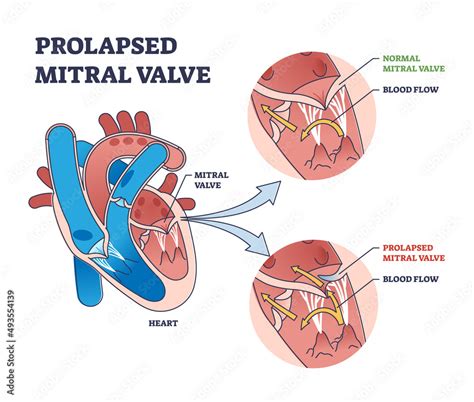 Prolapsed Mitral Valve Heart Disease Comparison With Normal Outline