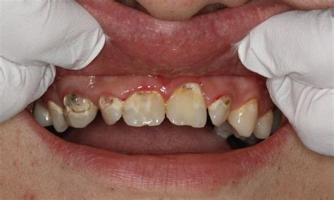 Front Tooth Cavity Filling