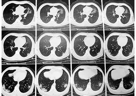 Chest Ct Scan Of Case 2 Shows Patchy Peripheral Ground Glass Opacities Download Scientific