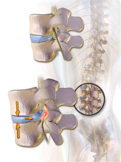 Bulging Disc Bye Bye Lower Back Pain