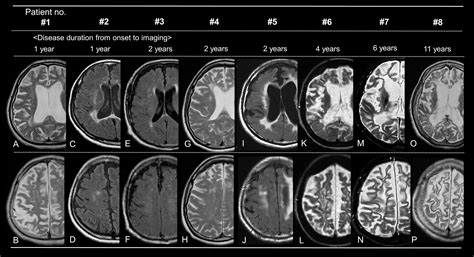 Adult Onset Leukoencephalopathy With Axonal Spheroids And Pigmented