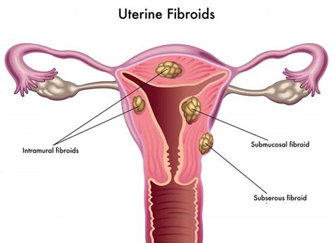 Uterine Sarcoma Classification Symptoms Causes And Treatment Scope