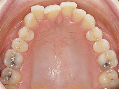 Clinical-Lingual-fig-5d : Scottish Dental magazine