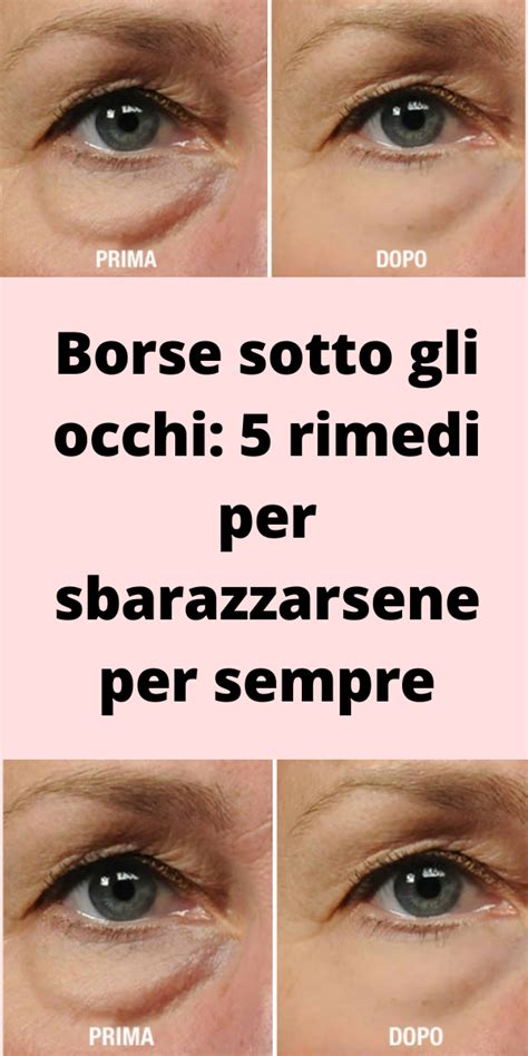 Borse Sotto Gli Occhi 5 Rimedi Per Sbarazzarsene Per Sempre Borse