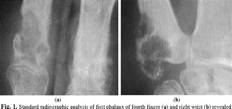 Figure 1 From Successful Treatment Of Osteolytic Epithelioid