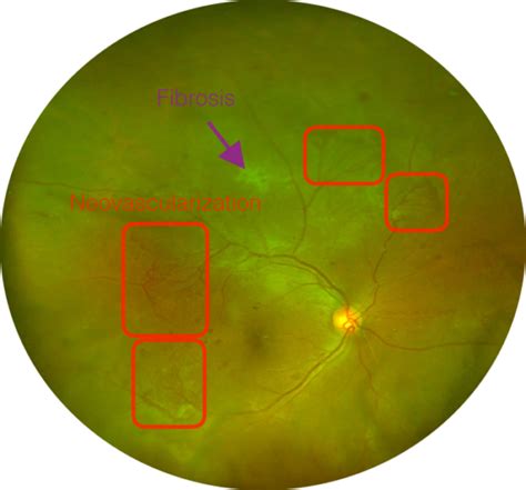 neovascularization-secondary-to-diabetic-retinopathy-labelled - EyeCarePD