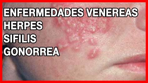 Enfermedades Venereas Y Fotos Hot Sex Picture