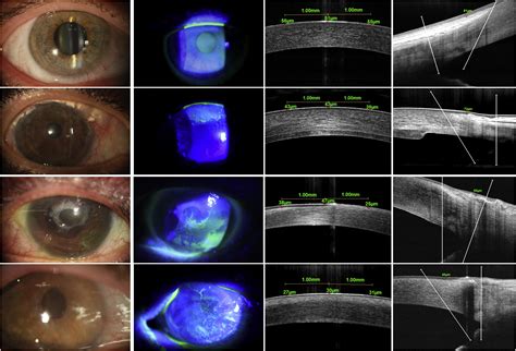 Corneal Epithelial Thickness Measured Using Anterior Segment Optical