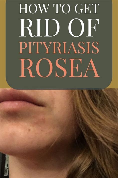 Pityriasis Rosea Home Remedies