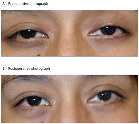 Role Of Algorithm Based Levator Aponeurectomy In Small Incision