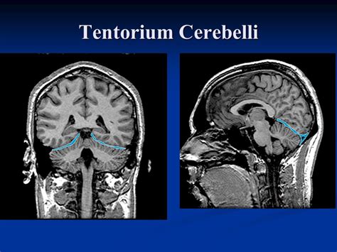 Tentorial Notch Brain And Illu Tentorium Sc 1 St Wikipedia