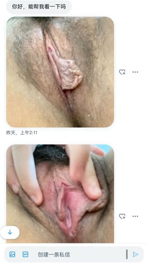 性治疗师Green on Twitter 处女图鉴 处女膜 阴道瓣 投稿 036 环形外凸阴道瓣外观中孔位置居中较完好