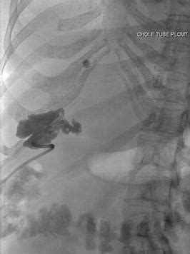 Bedside Percutaneous Cholecystostomy | IntechOpen