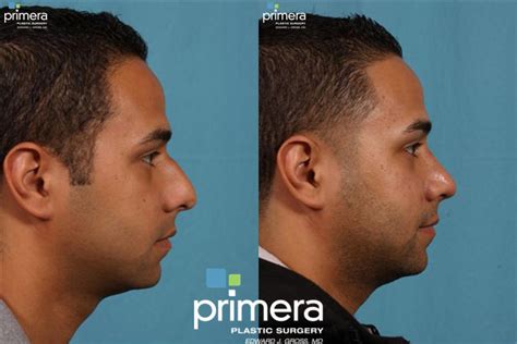 Cosmetic Plastic Surgery For Men Orlando And Winter Park Fl Primera