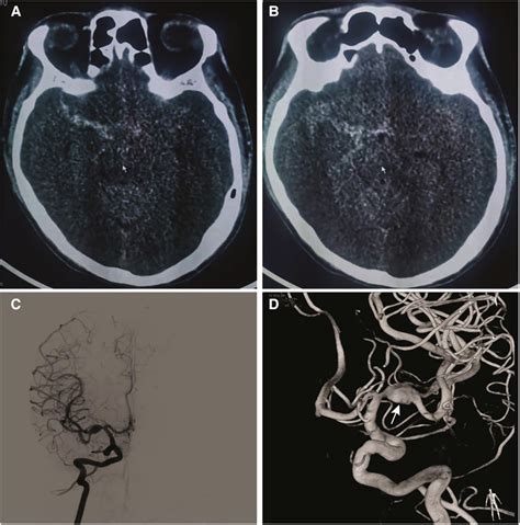 Frontiers Case Report Tubridge Flow Diverter For A Ruptured Fusiform