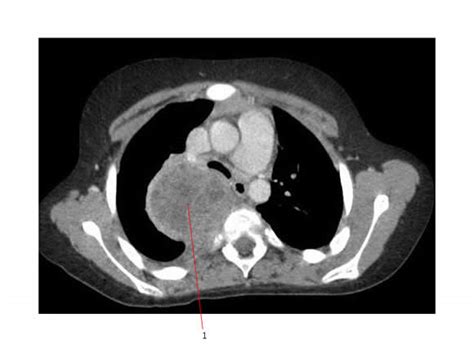 Differential Diagnosis Anterior Mediastinal Mass Differential Diagnosis