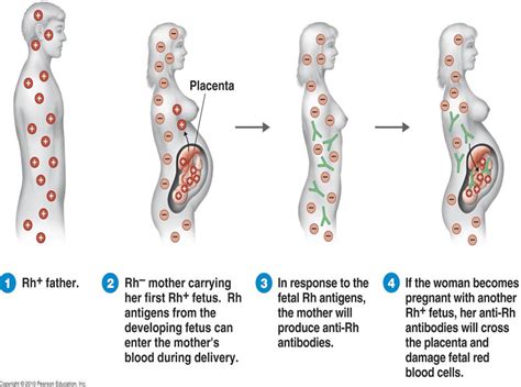 Erythroblastosis Fetalis Sequence Of Events