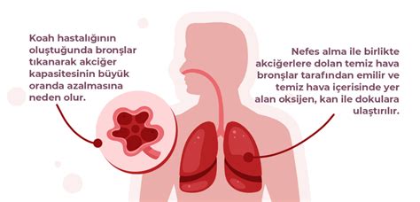 Koah Nedir Ve Nas L Tedavi Edilir