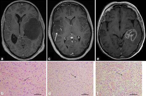 Gadolinium Retention In Gliomas And Adjacent Normal Brain Tissue