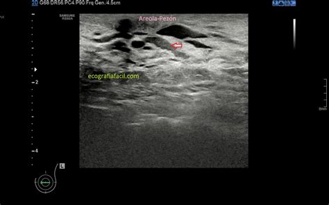 Duct Ectasia Histology