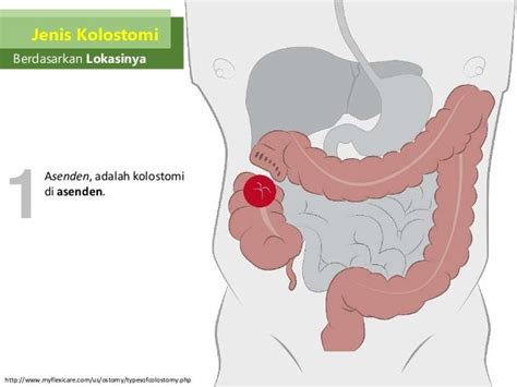 Modul 3 Kb3 Perawatan Dan Irigasi Kolostomi