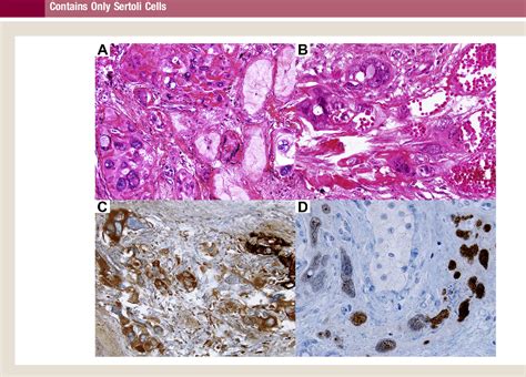 Figure 1 From Placental Site Trophoblastic Tumor In Nonseminomatous