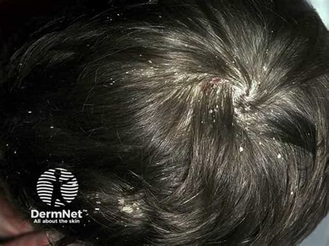 Scalp Psoriasis: A Complete Overview — DermNet