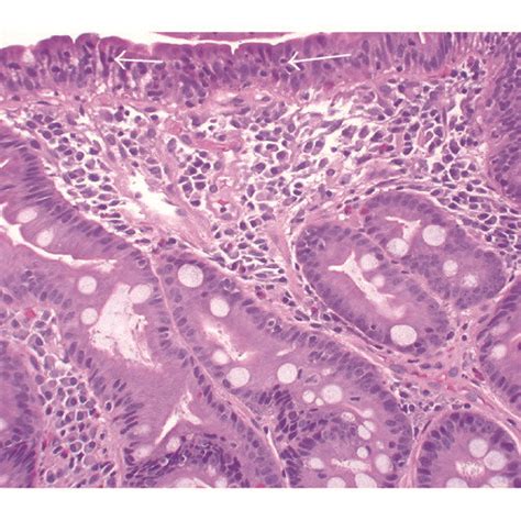 Duodenal Biopsy Specimen Showing Villous Blunting And Intraepithelial