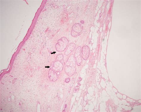 Squamous Cell Carcinoma Arising In A Mature Cystic Teratoma Invading