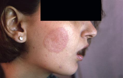 Superficial Fungal Infections Tinea Faciale Picture Hellenic Dermatological Atlas Over