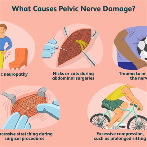 Pudendal Nerve Entrapment Syndromes Physiotherapy Treatment Exercise