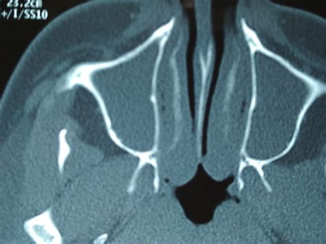 Discover How Turbinate Hypertrophy Causes Sleep Apnea Agony