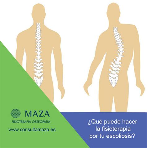 Kinesis Fisioterapia On X Qué Es La Escoliosis Y Cómo 57 OFF