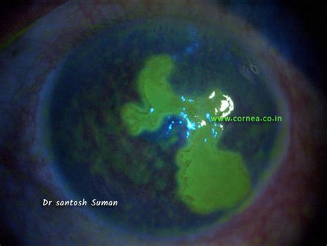 Dendrites – Cornea