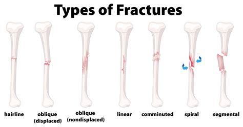 Bone Fracture Clip Art