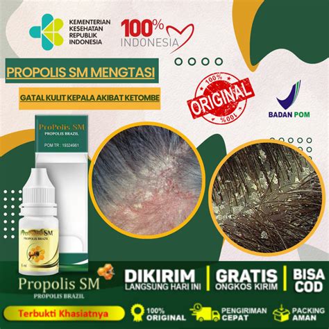 Jual Obat Penghilang Gatal Di Kulit Kepala Akibat Infeksi Jamur