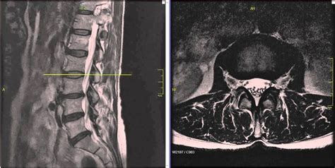 Lumbar Disc Herniation Mri Reading Chiropractic Treatment Whiplash Hot Sex Picture