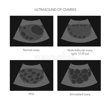 Medical Vector Illustration of Ovaries Ultrasound with Normal ...